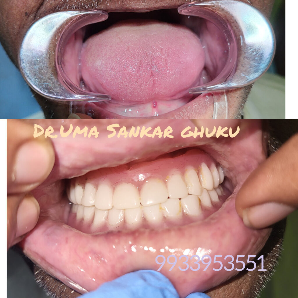 Before and after of a full mouth denture restoration by Dr. Uma Sankar Ghuku in Bagnan.