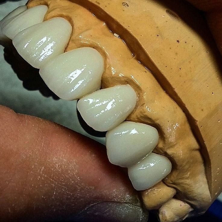 Custom porcelain dental bridge and crowns for tooth replacement in Bagnan.