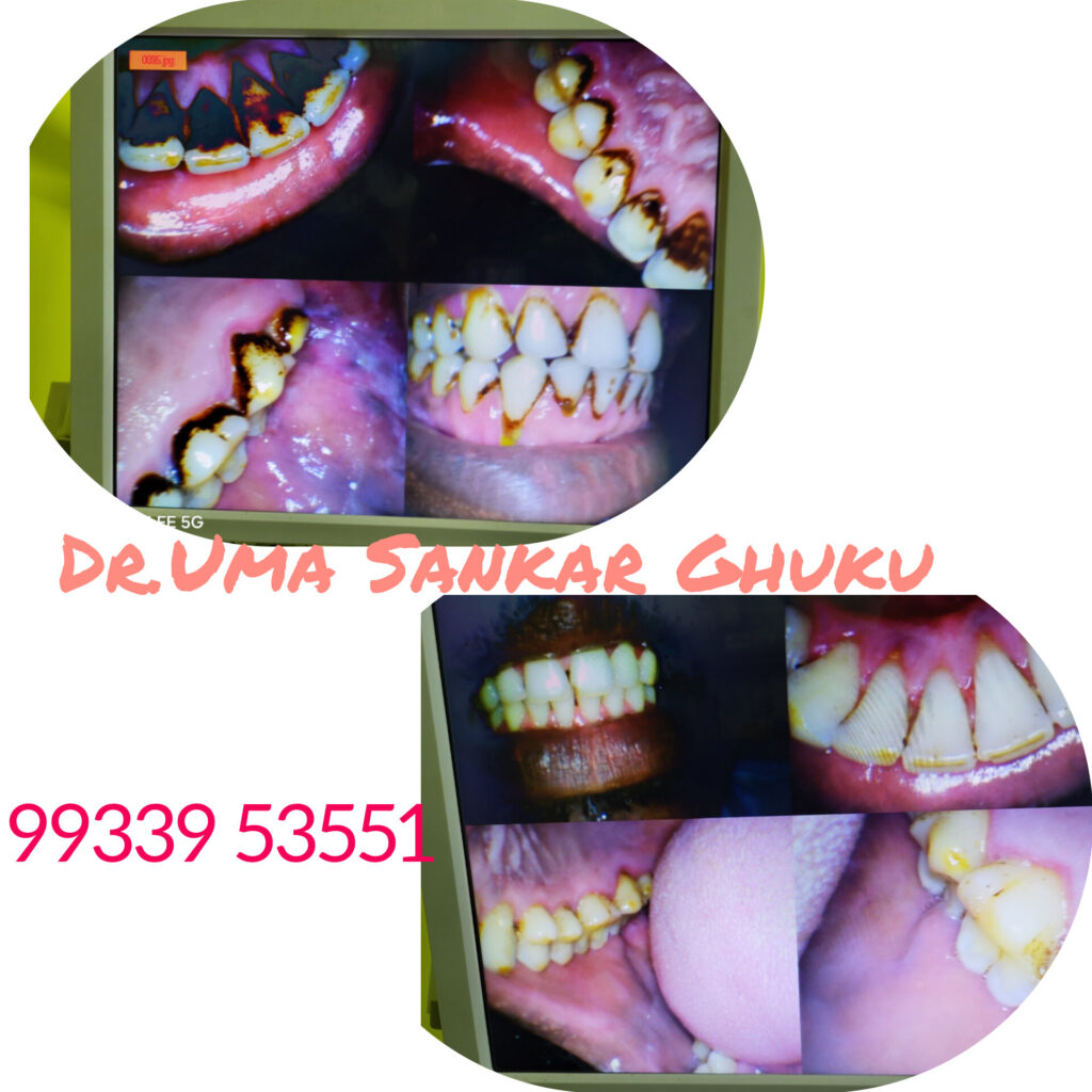 Professional dental scaling and polishing for heavy stain removal at a clinic in Bagnan.