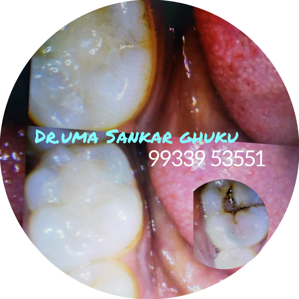 Tooth cavity filling and restoration treatment provided by Dr. Uma Sankar Ghuku in Bagnan.